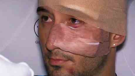 Fussballer mit Kopftrauma ins Krankenhaus eingeliefert nachdem Schlaeger den Mannschaftsbus