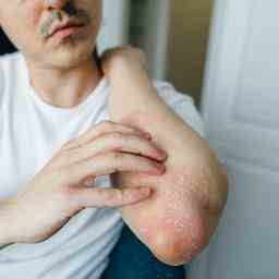 Das muessen Sie ueber Psoriasis wissen „Die Hautkrankheit ist nicht