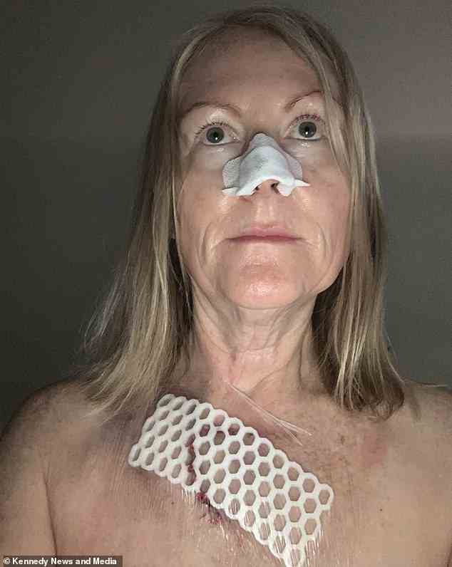 Mère d'un enfant après une intervention chirurgicale pour retirer un cancer de la peau de son sein et de son nez