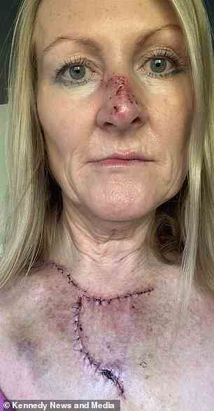 Mme Murray photographiée après l'opération.  Elle en a subi deux parce que le cancer avait atteint quatre pouces de profondeur