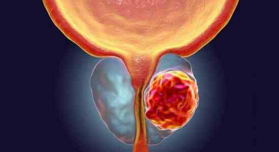 Letrange cas de lhomme atteint dun cancer de la prostate