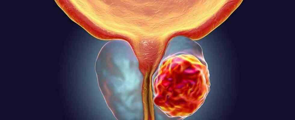 Letrange cas de lhomme atteint dun cancer de la prostate