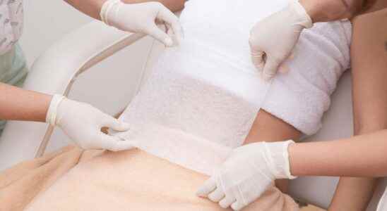 Cryolipolysis what is it