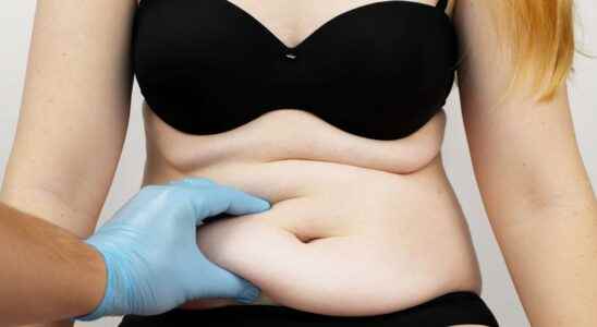 Tummy tuck what is it