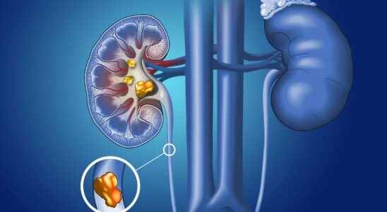 Renal colic what is it