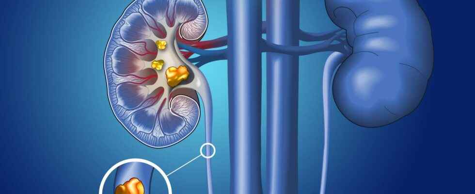Renal colic what is it
