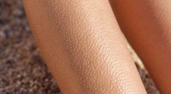 Why do we have goose bumps