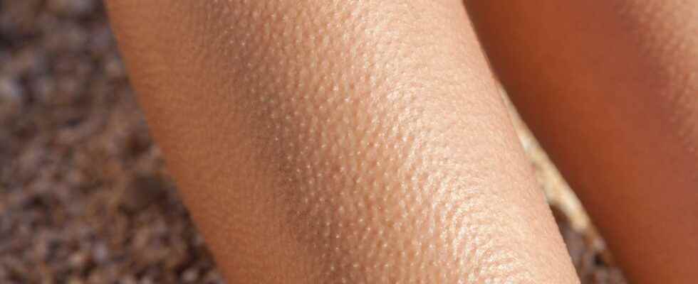 Why do we have goose bumps