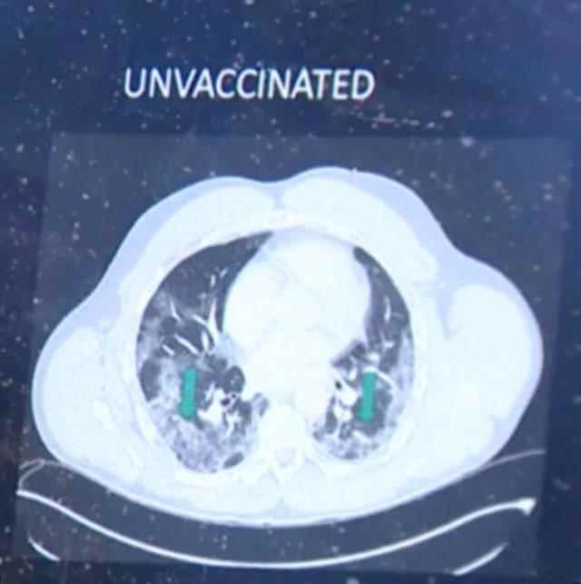 X-ray result of unvaccinated patient