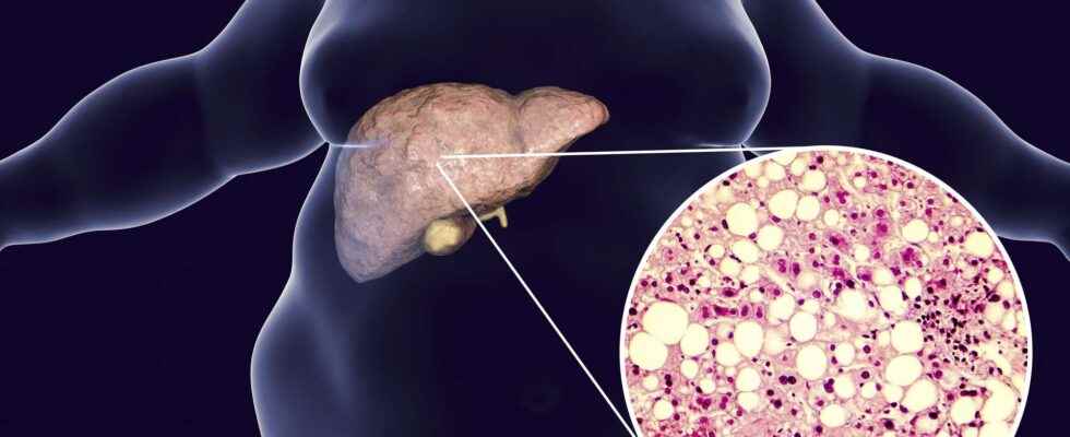 Fatty liver disease is it reversible