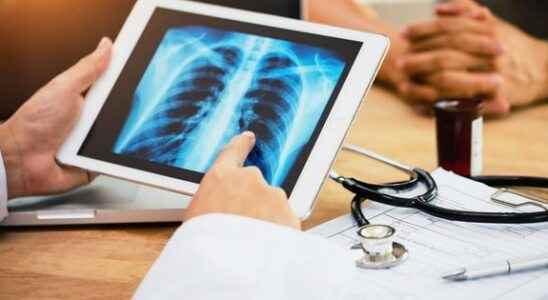 Lung cancer non smokers increasingly affected