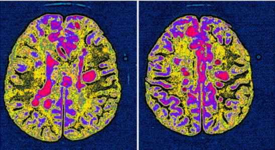 Researchers identify a virus as responsible for multiple sclerosis