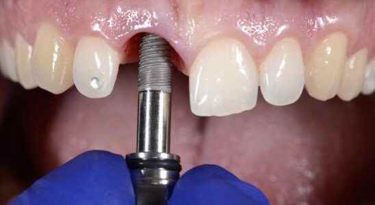 What are the most commonly preferred methods in implant dental