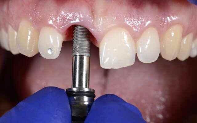 What are the most commonly preferred methods in implant dental
