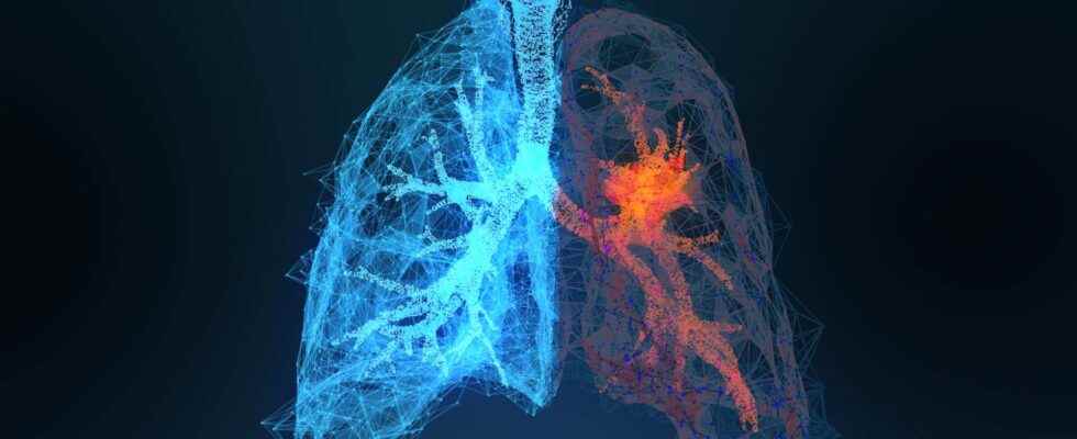 Why are lung cancers increasing in women and non smokers