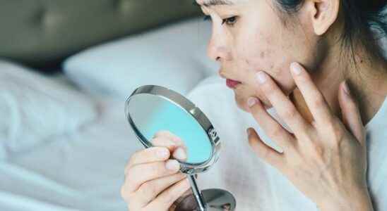 Acne a next algae based treatment could see the light of