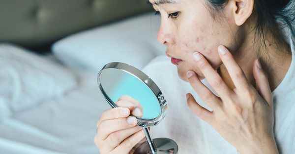 Acne a next algae based treatment could see the light of