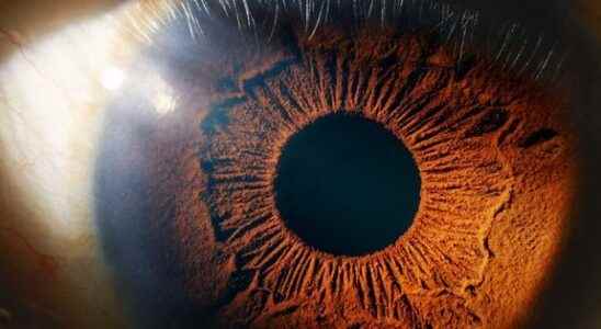 Alzheimers early signs detectable in the eye