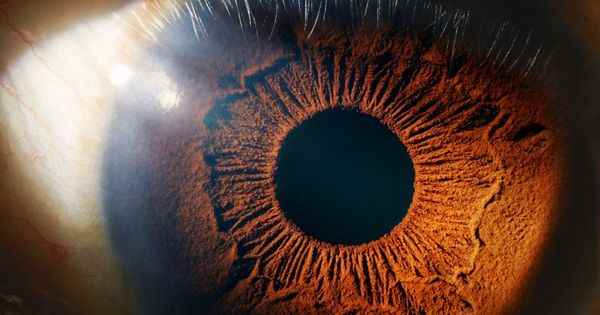 Alzheimers early signs detectable in the eye