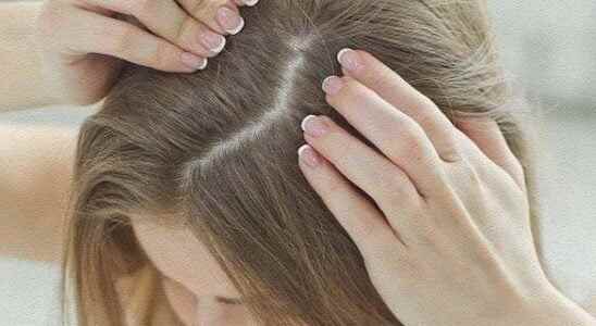 Dandruff problem becomes history thanks to homemade mixture