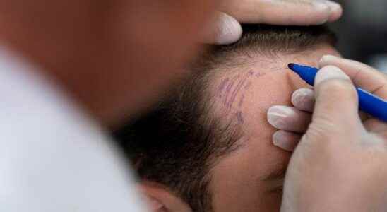 Know these before hair transplant It is vital