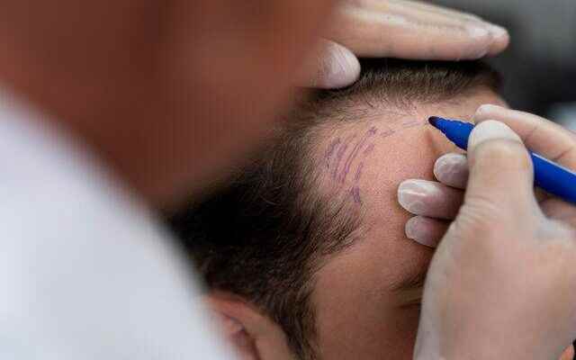 Know these before hair transplant It is vital