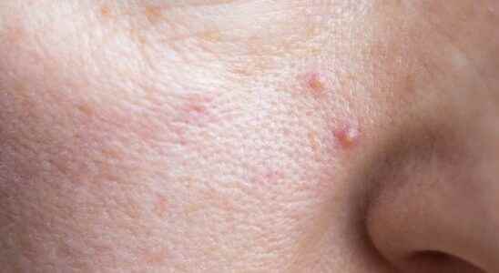 Several genes responsible for acne identified
