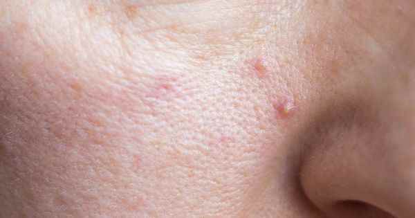 Several genes responsible for acne identified