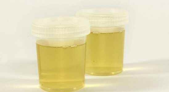 Urine color warns of diseases