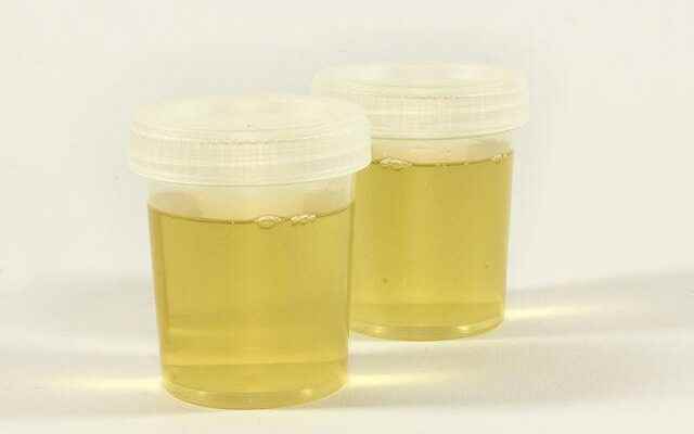 Urine color warns of diseases