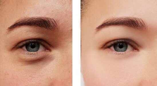 Ways to cover under eye circles without make up