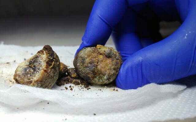 What is gallbladder stone how is it formed what are