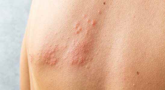 Low immune system causes shingles