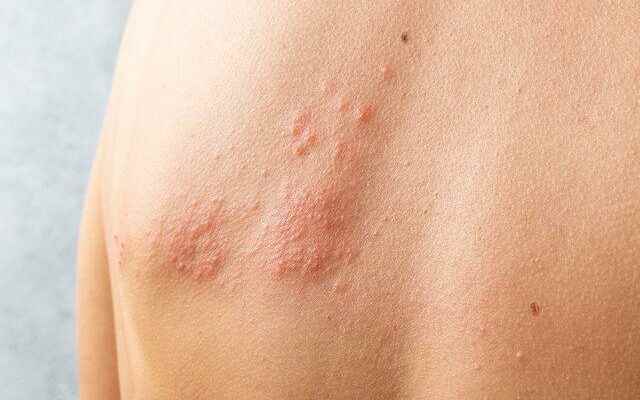 Low immune system causes shingles