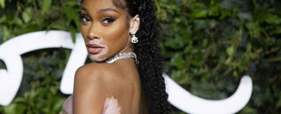 Model Winnie Harlow launches her brand of sun care products