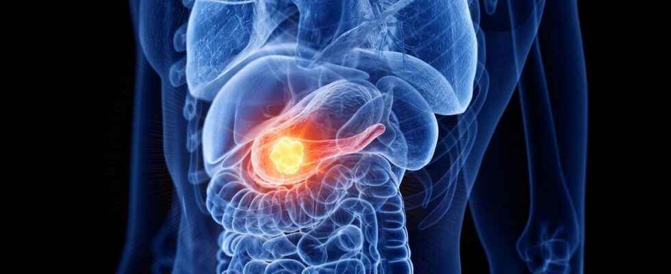 Pancreatic cancer towards early detection through stool analysis