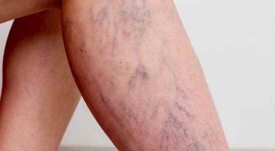 What are the causes and symptoms of varicose veins Here