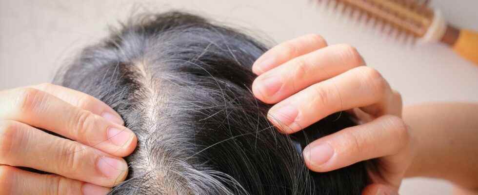 Where does dandruff come from and how to get rid