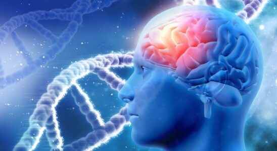 Alzheimers 75 new genetic risk factors associated with the disease