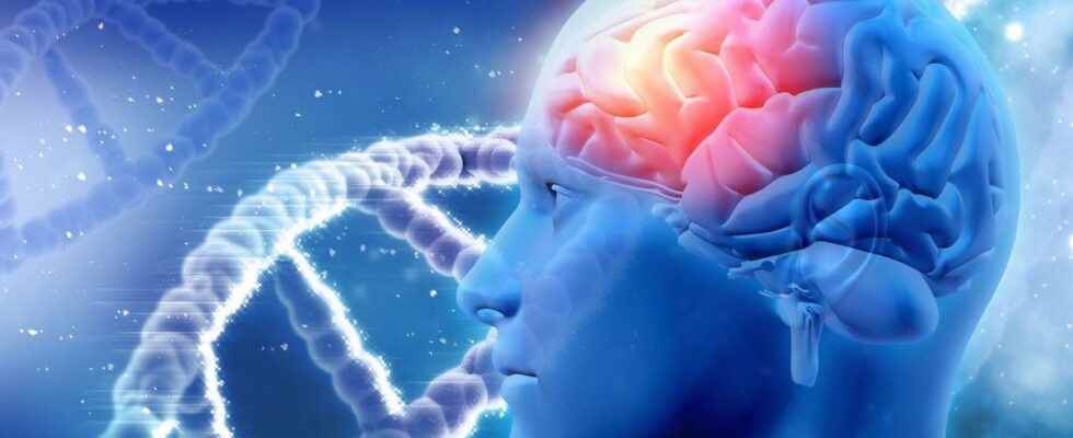 Alzheimers 75 new genetic risk factors associated with the disease