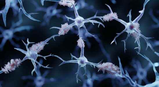 Alzheimers disease 75 genetic risk factors have been identified