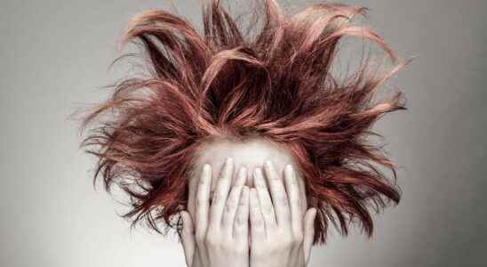 Bizarre patient this strange disease that makes hair indomitable