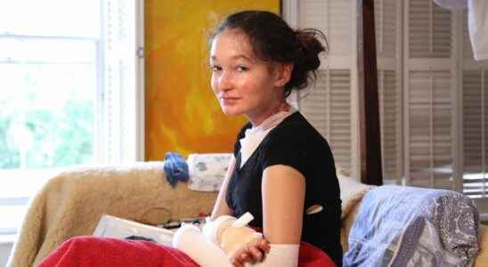 Epidermolysis bullosa a gel to cure patients
