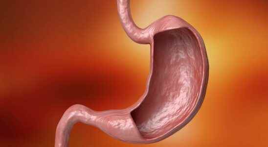Gastrectomy what is it
