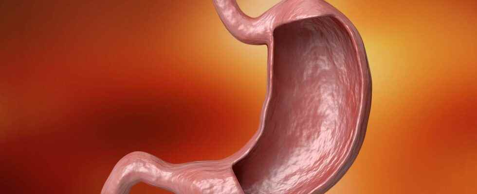 Gastrectomy what is it