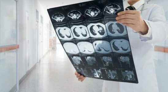 Kidney disease patients beware Definitely go for a cancer checkup