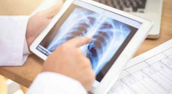Lung cancer a new treatment reduces the risk of recurrence