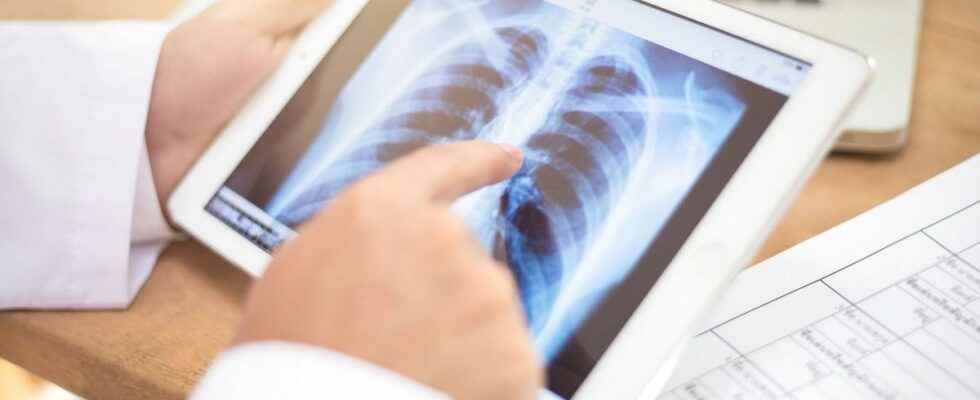 Lung cancer a new treatment reduces the risk of recurrence