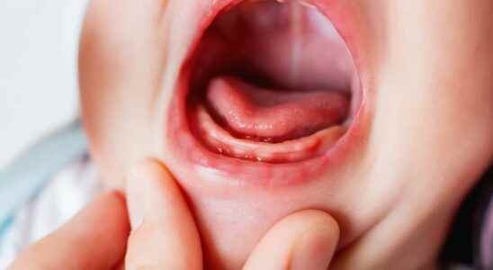 Tongue brake a controversial subject with multiple consequences