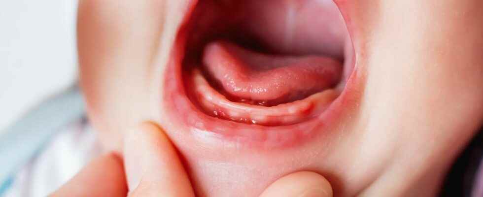 Tongue brake a controversial subject with multiple consequences